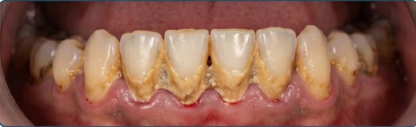 Before — heavy tartar buildup
