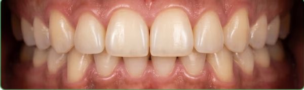 After — clean smooth teeth