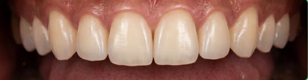 After — polished bright teeth